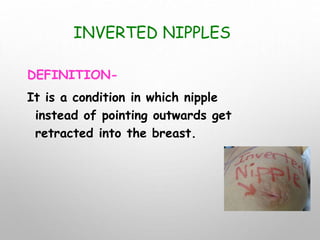 INVERTED NIPPLES
DEFINITION-
It is a condition in which nipple
instead of pointing outwards get
retracted into the breast.
 