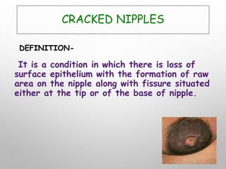 CRACKED NIPPLES
DEFINITION-
It is a condition in which there is loss of
surface epithelium with the formation of raw
area on the nipple along with fissure situated
either at the tip or of the base of nipple.
 