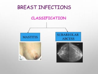 BREAST INFECTIONS
CLASSIFICATION
MASTITIS
SUBAREOLAR
ABCESS
 
