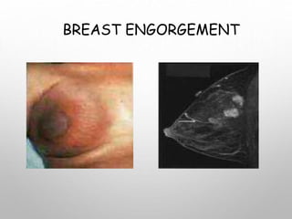 BREAST ENGORGEMENT
 