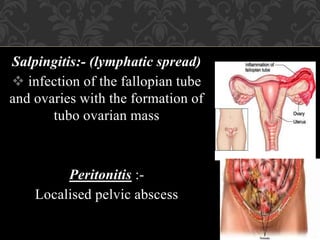 Salpingitis:- (lymphatic spread)
 infection of the fallopian tube
and ovaries with the formation of
tubo ovarian mass
Peritonitis :-
Localised pelvic abscess
 
