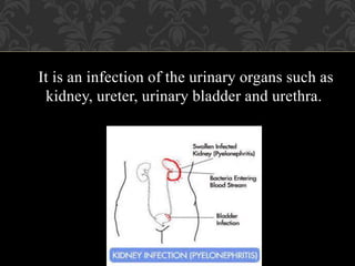 It is an infection of the urinary organs such as
kidney, ureter, urinary bladder and urethra.
 