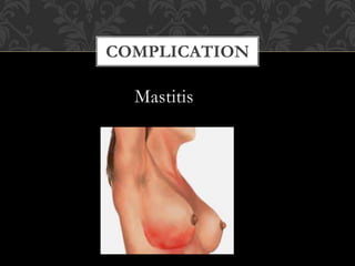 COMPLICATION
Mastitis
 