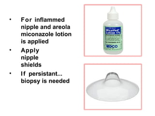 • For inflammed
nipple and areola
miconazole lotion
is applied
• Apply
nipple
shields
• If persistant...
biopsy is needed
 