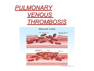 PULMONARY
VENOUS
THROMBOSIS
 