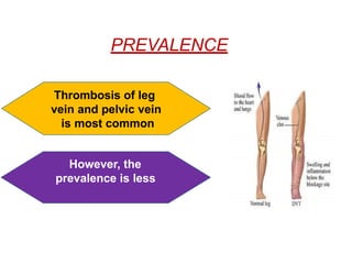 PREVALENCE
Thrombosis of leg
vein and pelvic vein
is most common
However, the
prevalence is less
 