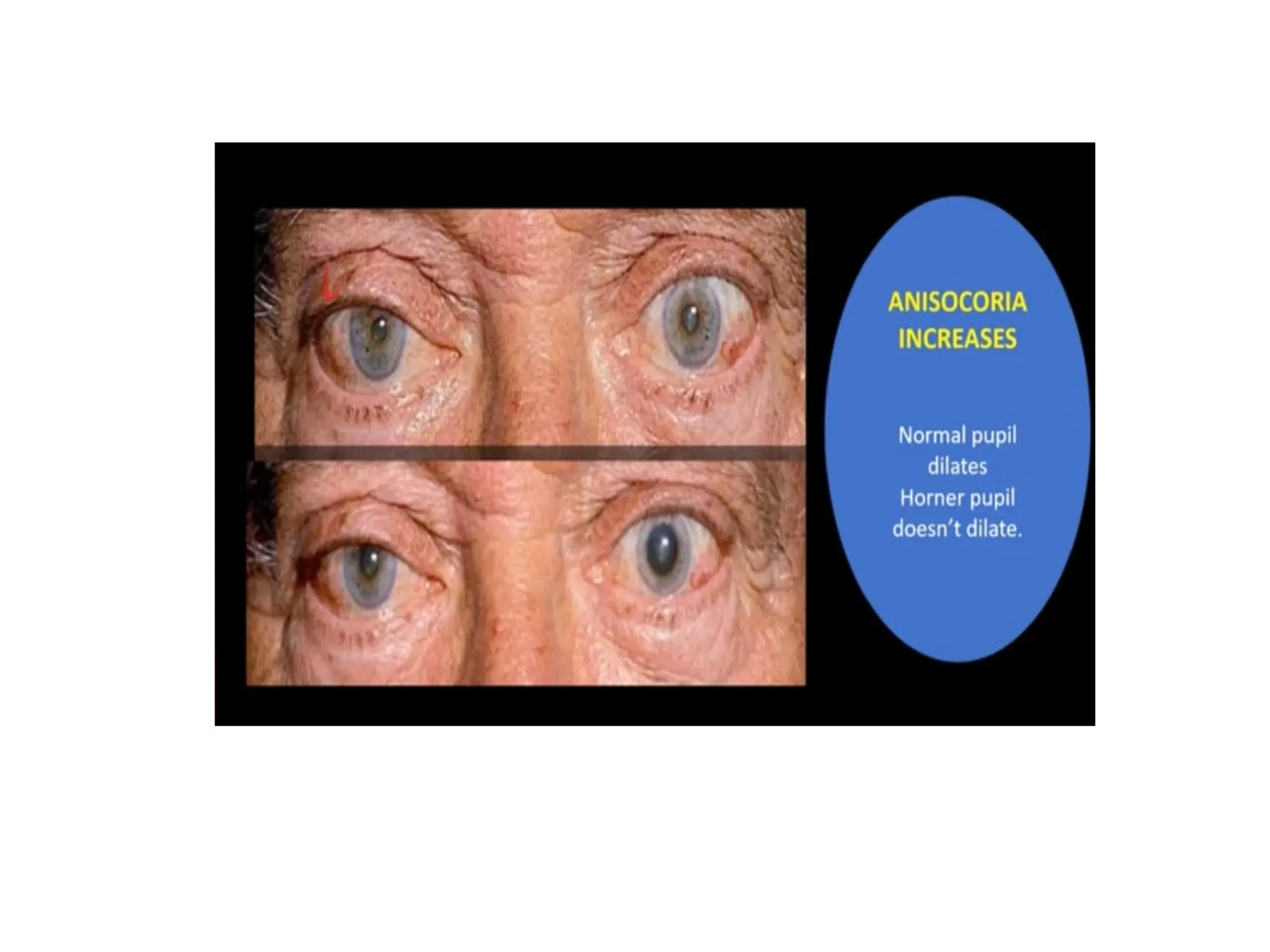 abnormal pupillary reflexes final.pptxAbnormal pupillary reflexes ...
