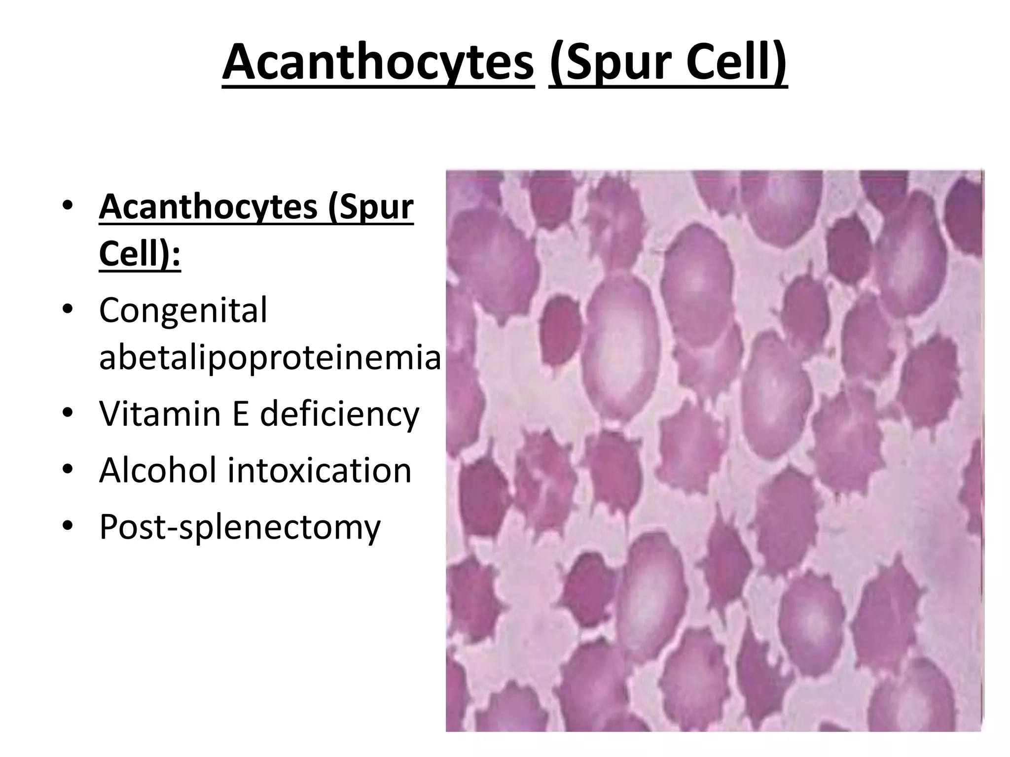 Abnormal red blood cell morphologies | PPTX