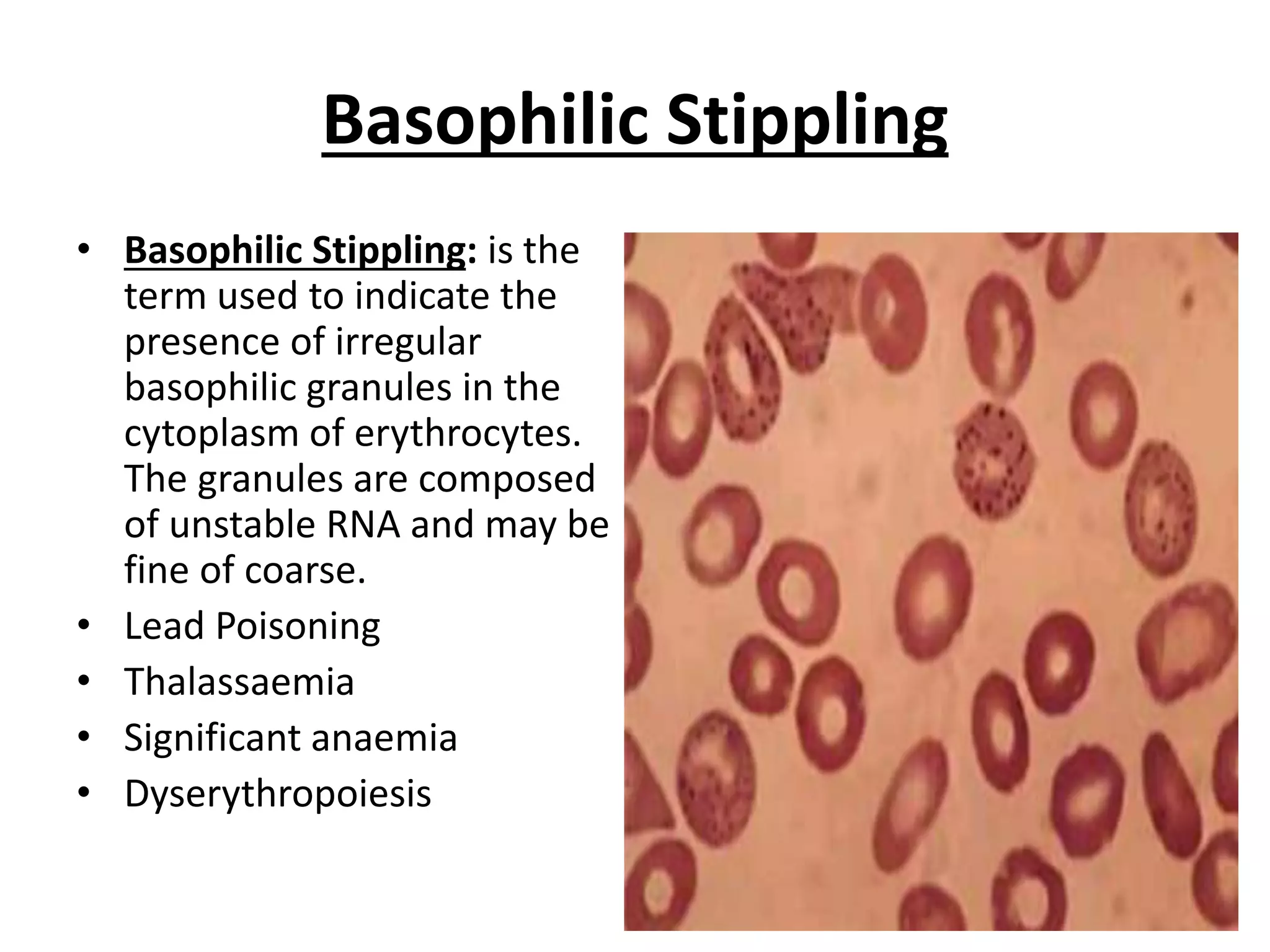 Abnormal red blood cell morphologies | PPTX