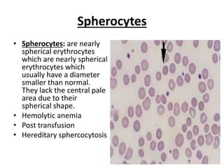 Abnormal red blood cell morphologies | PPTX