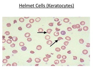 Abnormal red blood cell morphologies | PPTX