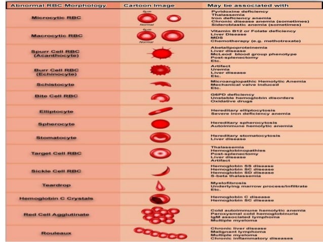 abnormal red blood cell morphologies abnormal rbc morphology