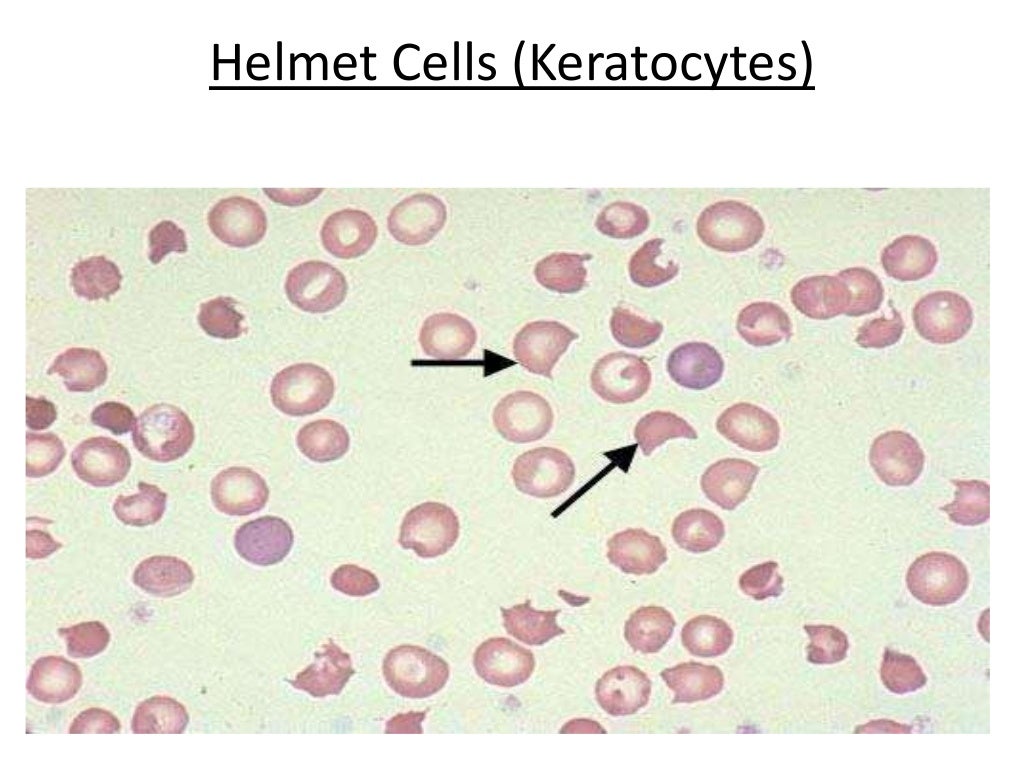 Abnormal red blood cell morphologies