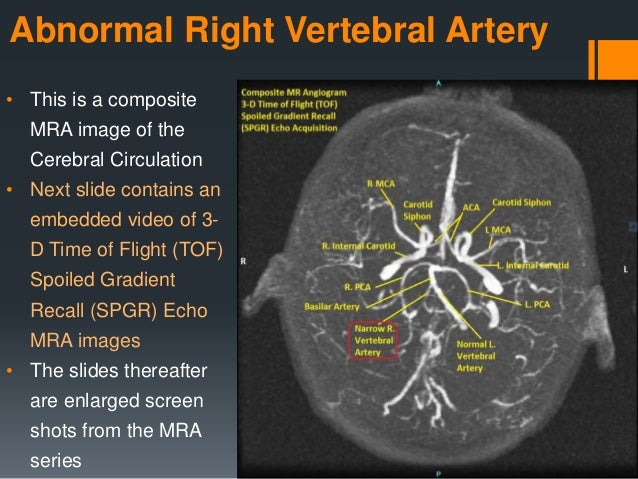Abnormal Right Vertebral Artery MRA Sequence - Sanjoy Sanyal