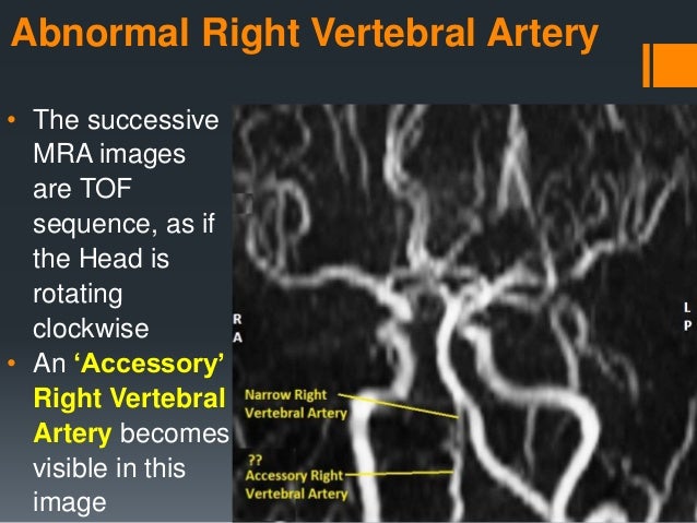 Abnormal Right Vertebral Artery MRA Sequence - Sanjoy Sanyal