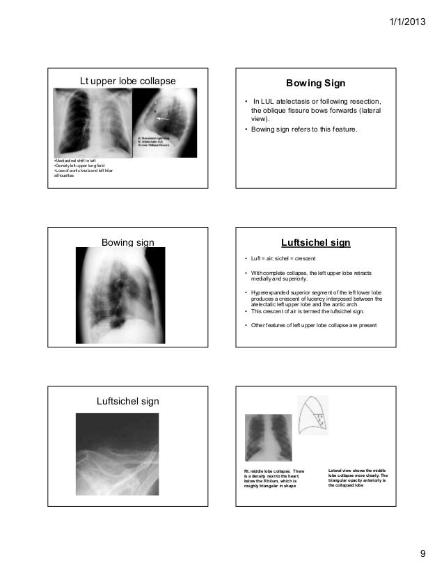 Abnormal sign in chest X Ray