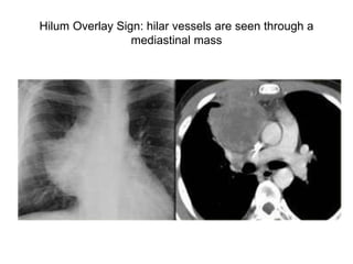Hilum Overlay Sign: hilar vessels are seen through a
mediastinal mass
 