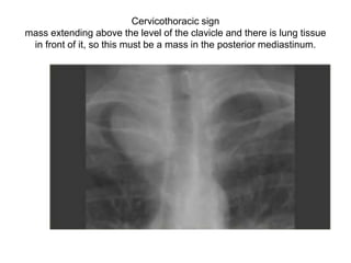 Cervicothoracic sign
mass extending above the level of the clavicle and there is lung tissue
in front of it, so this must be a mass in the posterior mediastinum.
 