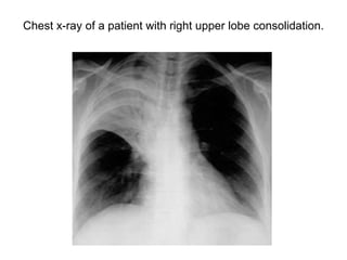 Chest x-ray of a patient with right upper lobe consolidation.
 
