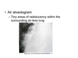• Air alveologram
– Tiny areas of radiolucency within the
surrounding air-less lung
 