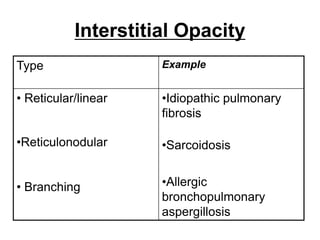 Interstitial Opacity
Type Example
• Reticular/linear
•Reticulonodular
• Branching
•Idiopathic pulmonary
fibrosis
•Sarcoidosis
•Allergic
bronchopulmonary
aspergillosis
 