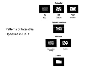 Patterns of Interstitial
Opacities in CXR
 