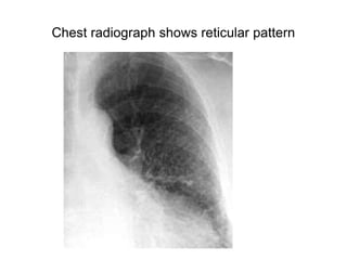 Chest radiograph shows reticular pattern
 