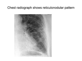 Chest radiograph shows reticulonodular pattern
 