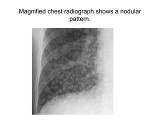 Magnified chest radiograph shows a nodular
pattern.
 