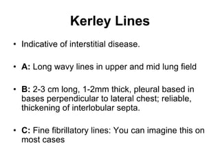 Kerley Lines
• Indicative of interstitial disease.
• A: Long wavy lines in upper and mid lung field
• B: 2-3 cm long, 1-2mm thick, pleural based in
bases perpendicular to lateral chest; reliable,
thickening of interlobular septa.
• C: Fine fibrillatory lines: You can imagine this on
most cases
 