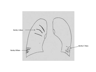 Kerley C lines
Kerley A lines
Kerley B lines
 