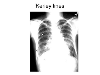 Kerley lines
 