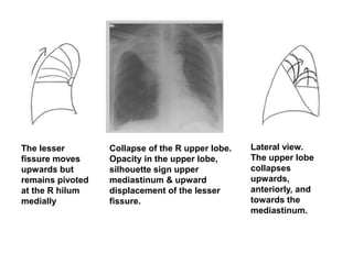 The lesser
fissure moves
upwards but
remains pivoted
at the R hilum
medially
Lateral view.
The upper lobe
collapses
upwards,
anteriorly, and
towards the
mediastinum.
Collapse of the R upper lobe.
Opacity in the upper lobe,
silhouette sign upper
mediastinum & upward
displacement of the lesser
fissure.
 