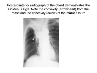 Posteroanterior radiograph of the chest demonstrates the
Golden S sign. Note the convexity (arrowhead) from the
mass and the concavity (arrow) of the minor fissure
 