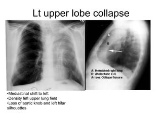 Lt upper lobe collapse
•Mediastinal shift to left
•Density left upper lung field
•Loss of aortic knob and left hilar
silhouettes
 