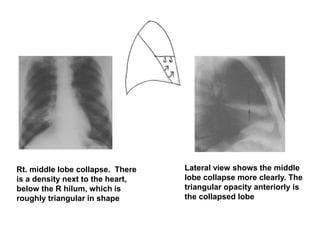 Rt. middle lobe collapse. There
is a density next to the heart,
below the R hilum, which is
roughly triangular in shape
Lateral view shows the middle
lobe collapse more clearly. The
triangular opacity anteriorly is
the collapsed lobe
 