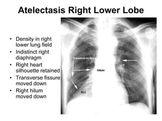 Atelectasis Right Lower Lobe
• Density in right
lower lung field
• Indistinct right
diaphragm
• Right heart
silhouette retained
• Transverse fissure
moved down
• Right hilum
moved down
 