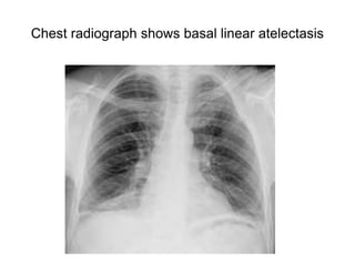 Chest radiograph shows basal linear atelectasis
 