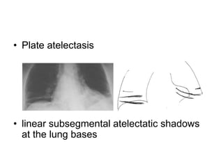 • Plate atelectasis
• linear subsegmental atelectatic shadows
at the lung bases
 
