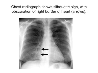 Chest radiograph shows silhouette sign, with
obscuration of right border of heart (arrows).
 