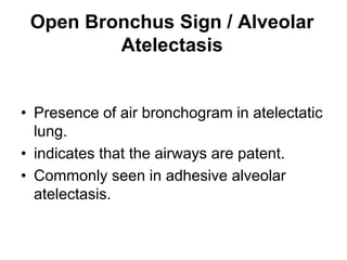 Open Bronchus Sign / Alveolar
Atelectasis
• Presence of air bronchogram in atelectatic
lung.
• indicates that the airways are patent.
• Commonly seen in adhesive alveolar
atelectasis.
 