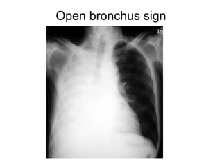 Open bronchus sign
 