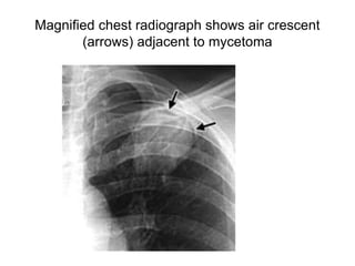 Magnified chest radiograph shows air crescent
(arrows) adjacent to mycetoma
 