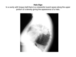 Halo Sign
In a cavity with fungus ball there is a crescentic lucent space along the upper
portion of a density giving the appearance of a halo.
 