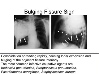 Bulging Fissure Sign
Consolidation spreading rapidly, causing lobar expansion and
bulging of the adjacent fissure inferiorly .
The most common infective causative agents are
Klebsiella pneumoniae, Streptococcus pneumoniae,
Pseudomonas aeruginosa, Staphylococcus aureus
 