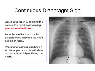 Continuous Diaphragm Sign
Continuous lucency outlining the
base of the heart, representing
pneumomediastinum .
Air in the mediastinum tracks
extrapleurally, between the heart
and diaphragm .
Pneumopericardium can have a
similar appearance but will show
air circumferentially outlining the
heart.
 