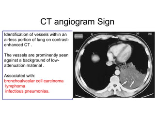 CT angiogram Sign
Identification of vessels within an
airless portion of lung on contrast-
enhanced CT .
The vessels are prominently seen
against a background of low-
attenuation material .
Associated with:
bronchoalveolar cell carcinoma
lymphoma
infectious pneumonias.
 