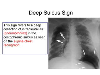 Deep Sulcus Sign
This sign refers to a deep
collection of intrapleural air
(pneumothorax) in the
costophrenic sulcus as seen
on the supine chest
radiograph .
 