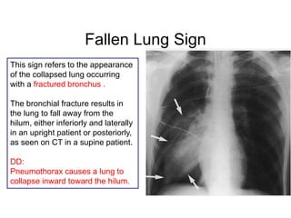 Fallen Lung Sign
This sign refers to the appearance
of the collapsed lung occurring
with a fractured bronchus .
The bronchial fracture results in
the lung to fall away from the
hilum, either inferiorly and laterally
in an upright patient or posteriorly,
as seen on CT in a supine patient.
DD:
Pneumothorax causes a lung to
collapse inward toward the hilum.
 