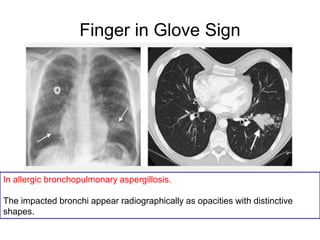 Finger in Glove Sign
In allergic bronchopulmonary aspergillosis.
The impacted bronchi appear radiographically as opacities with distinctive
shapes.
 